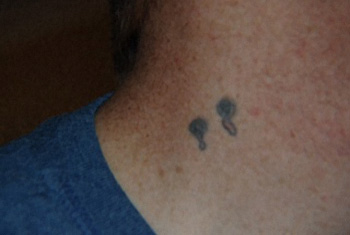 Before Tattoo Removal